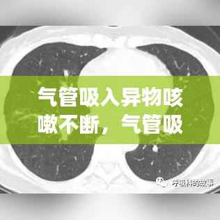 气管吸入异物咳嗽不断,气管吸入异物一般多久开始有症状